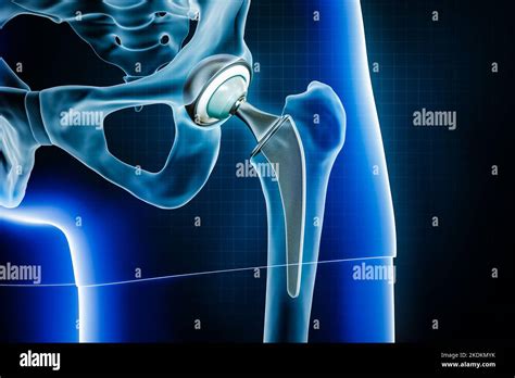 Femoral head hip prosthesis or implant. Total hip joint replacement surgery or arthroplasty 3D ...