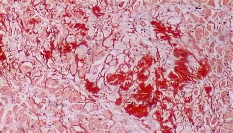 Alkaline Congo Red Staining Technique for Amyloid : Principle, Procedure and Interpretation ...