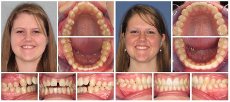 Invisalign | Associate Implant & Family Dentistry | Bellingham, WA