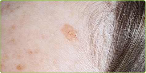 Eskata treatments for SK lesions - Dy Dermatology Center