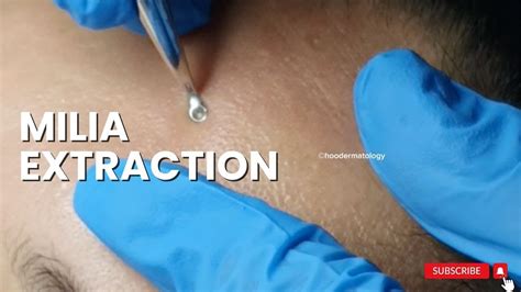 MILIA EXTRACTION ON THE FOREHEAD - YouTube