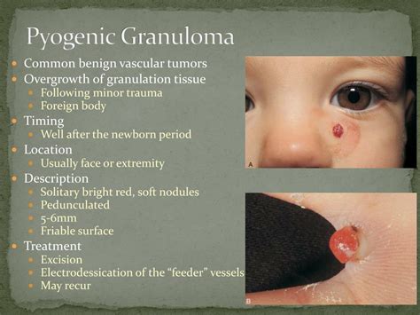 PPT - Hemangiomas and Vascular Malformations PowerPoint Presentation, free download - ID:780098