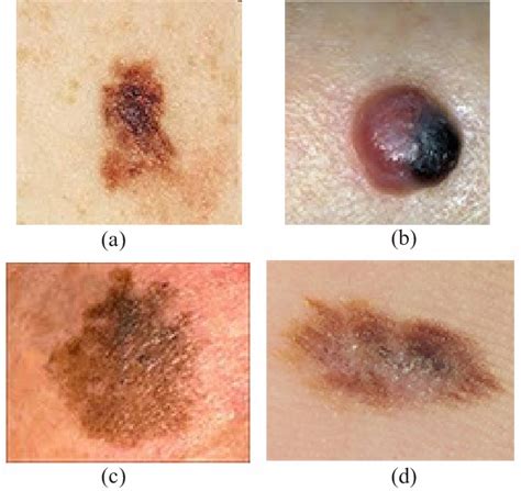 Malignant Melanoma Types. (a) Superficial Spreading Melanoma. (b)... | Download Scientific Diagram