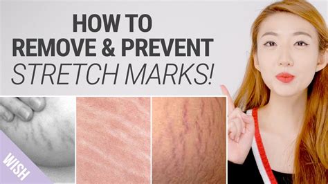 How To Prevent Or Get Rid Of Stretch Marks - Divisionhouse21