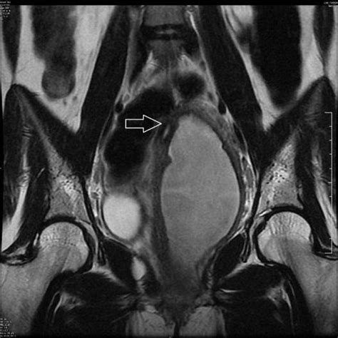 a. MRI pelvis (axial image) – Uterus didelphys, normal endometrial... | Download Scientific Diagram