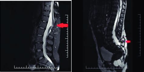 Thoracic and lumbar lipomyelomeningocele (red arrows) on MRI. | Download Scientific Diagram