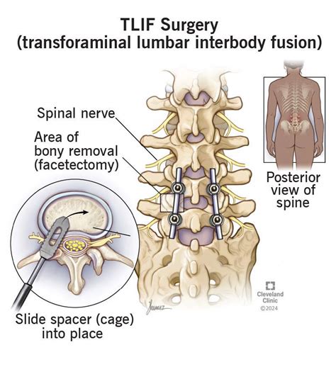 TLIF Surgery: What It Is, Purpose, Procedure & Recovery