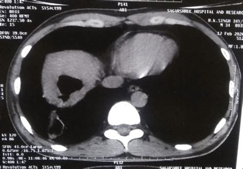 Hypodense lesion in Rt lobe. | Download Scientific Diagram