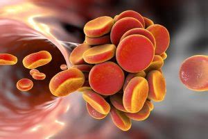 Thrombosis vs. Embolism: Symptoms, Causes, and Treatment