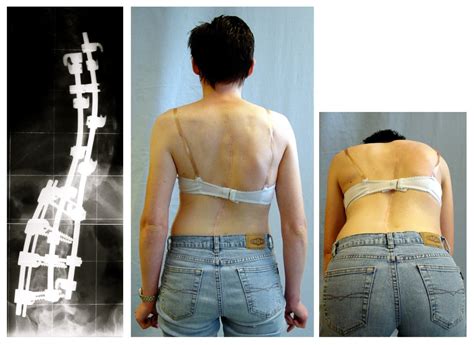 File:Result after scoliosis surgery.jpg - Wikimedia Commons