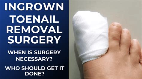 What is Ingrown Toenail removal surgery? How does it work? Does it hurt?