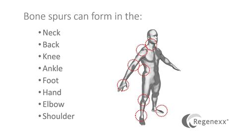 Hip Bone Spur Removal - Why You Should Avoid It - Regenexx®