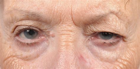 Eyelid Conditions : EYE PHYSICIANS S.C.