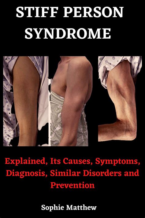 Stiff Person Syndrome Book: Explained, Its Causes, Symptoms, Diagnosis ...