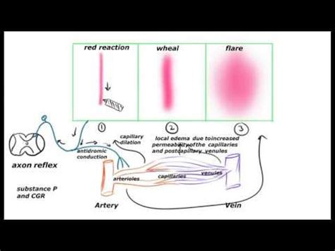 A Wheal and Flare Reaction Is Best Described as a - Maggie-has-Joseph