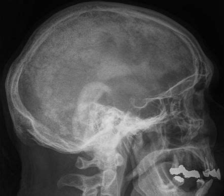 Paget disease (bone) | Radiology Reference Article | Radiopaedia.org