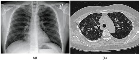 Sensors | Free Full-Text | COVID-19 Detection on Chest X-ray and CT Scan: A Review of the Top ...