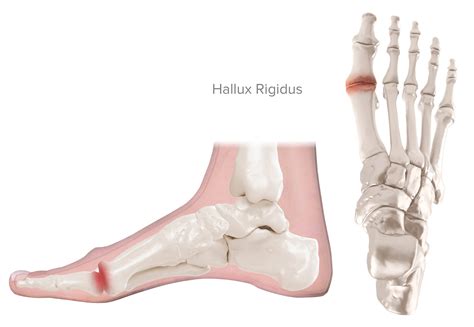 Hallux Rigidus – KevinRoot Medical