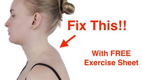 Easy Fix for the Neck Hump! (With FREE Exercise Sheet!) - YouTube ...