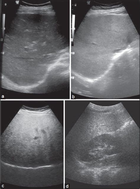 Grades of fatty liver on visual analysis. Ultrasound image shows (a) Normal liver echogenicity ...