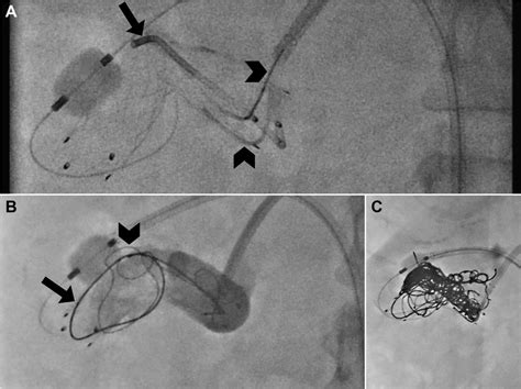 A, Right renal angiogram showing status after deployment of a... | Download Scientific Diagram