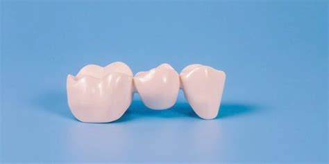 What Is A Fixed Dental Bridge? Advantages and Disadvantages - % Clínica ...