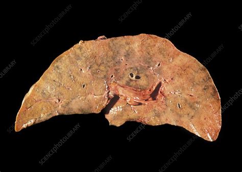 Necrosis of the liver - Stock Image - C022/7265 - Science Photo Library