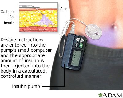 Type 1 Diabetes (T1D) Symptoms, Doctors, Treatments, Advances & More ...