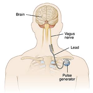 Understanding Vagus Nerve Stimulator (VNS) Placement | Saint Luke's ...