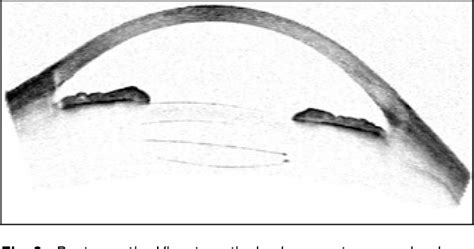 Figure 2 from The use of a supplemental sulcus fixated IOL (HumanOptics Add-On IOL) to correct ...