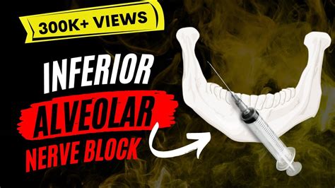 Inferior Alveolar Nerve block - YouTube