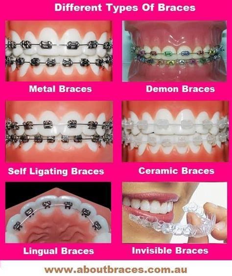 Image by OralPrecision.com on Dental Braces in 2020 | Types of braces, Different types of braces ...