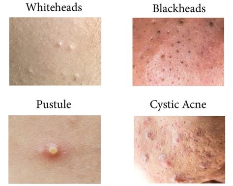 Dr. Pimple Popper Reveals the Acne You Shouldn't Pop | Reader's Digest