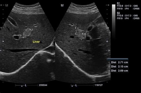 Hepatic Hemangioma Ultrasound