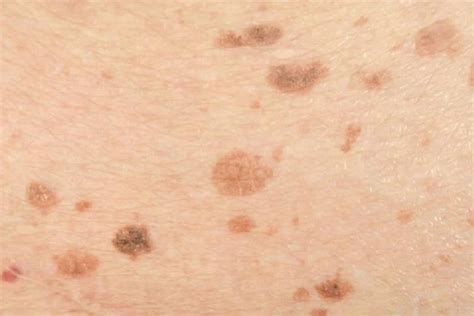 Dark Spots on the Skin – Causes, Diseases, Treatment and More