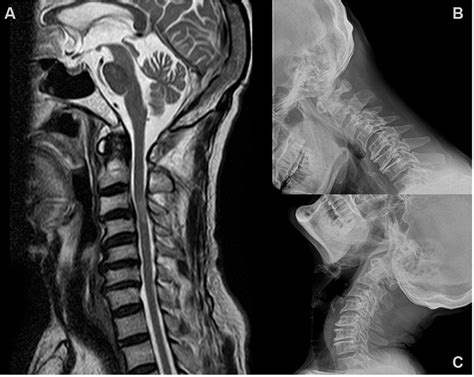 Role of dynamic MRI in occult cervical canal stenosis | BMJ Case Reports