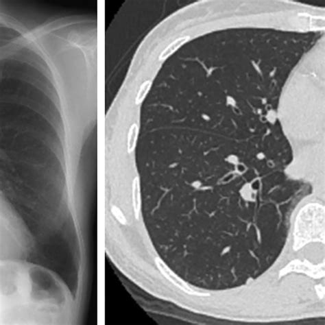 (A, B) Chest X-ray showed hyperinflation of the lungs. Chest ...