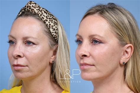 Laser Skin Resurfacing ( TRL ) Before and after photos, by Drs. Lieberman and Parikh at L&P ...