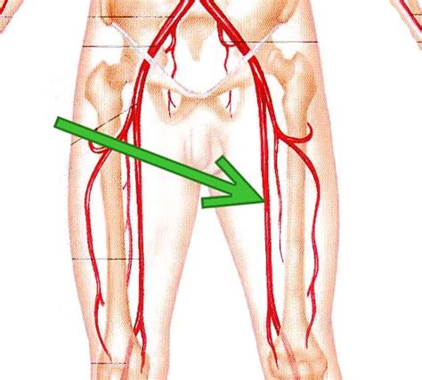 femoral artery location - ModernHeal.com