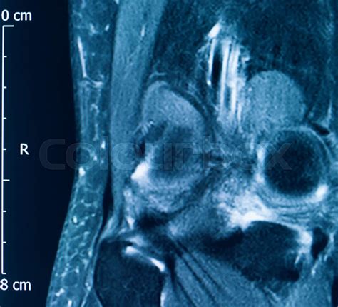 Knee injury mri mcl tear | Stock image | Colourbox