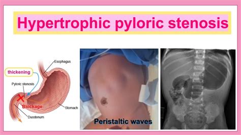 hypertrophic pyloric stenosis - YouTube