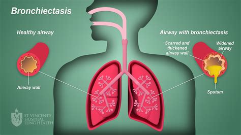 Bronchiectasis - St Vincent's Lung Health