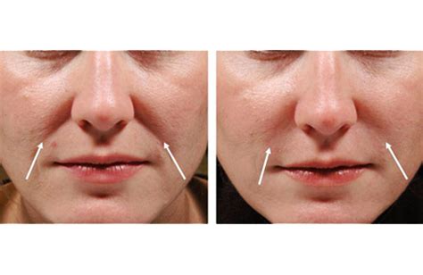 Treat smile lines around the mouth and nose using Juvederm. | Dermal ...