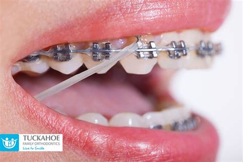 Orthodontic Rubber Bands Are an Important Part of Treatment