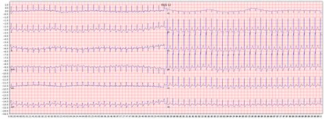 Psvt Ecg Clinical Practice Guidelines Supraventricular Tachycardia | The Best Porn Website