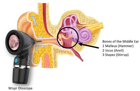 Hammer, Anvil & Stirrup by otoscopy. Bones of the middle ear. - WiscMed