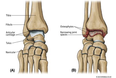 Ankle Arthritis — Ankle Arthritis | Ankle Replacement | Arthrodesis | Ankle Fusion