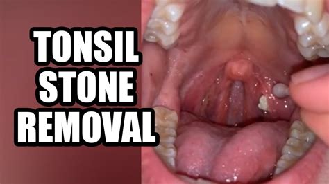Tonsil Stone Removal, Best of the Best - YouTube