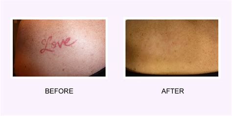 Tattoo Removal Before And After Scar