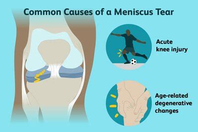 Meniscus Tear Treatment in NYC | Knee Pain Doctors Specialists New York